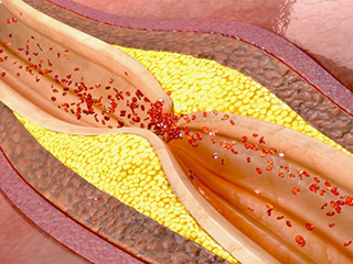 heart disease myths inflammation