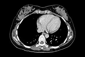 Coronary calcium scan